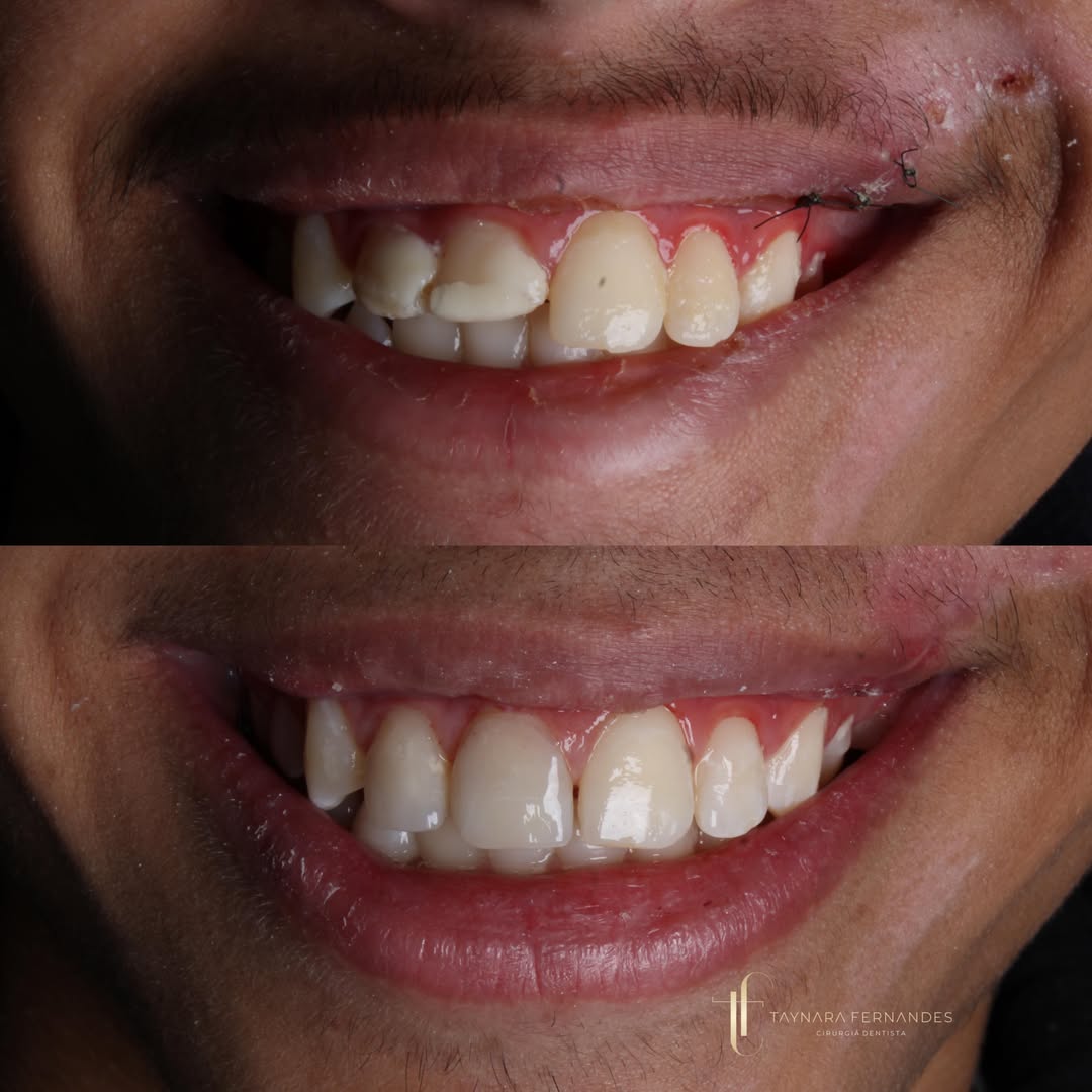 Sorriso Harmonizado (antes e depois)